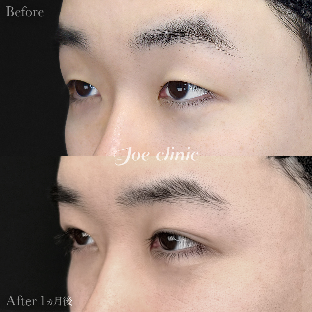 【20代男性】韓国式二重埋没法6点留め｜1ヵ月後