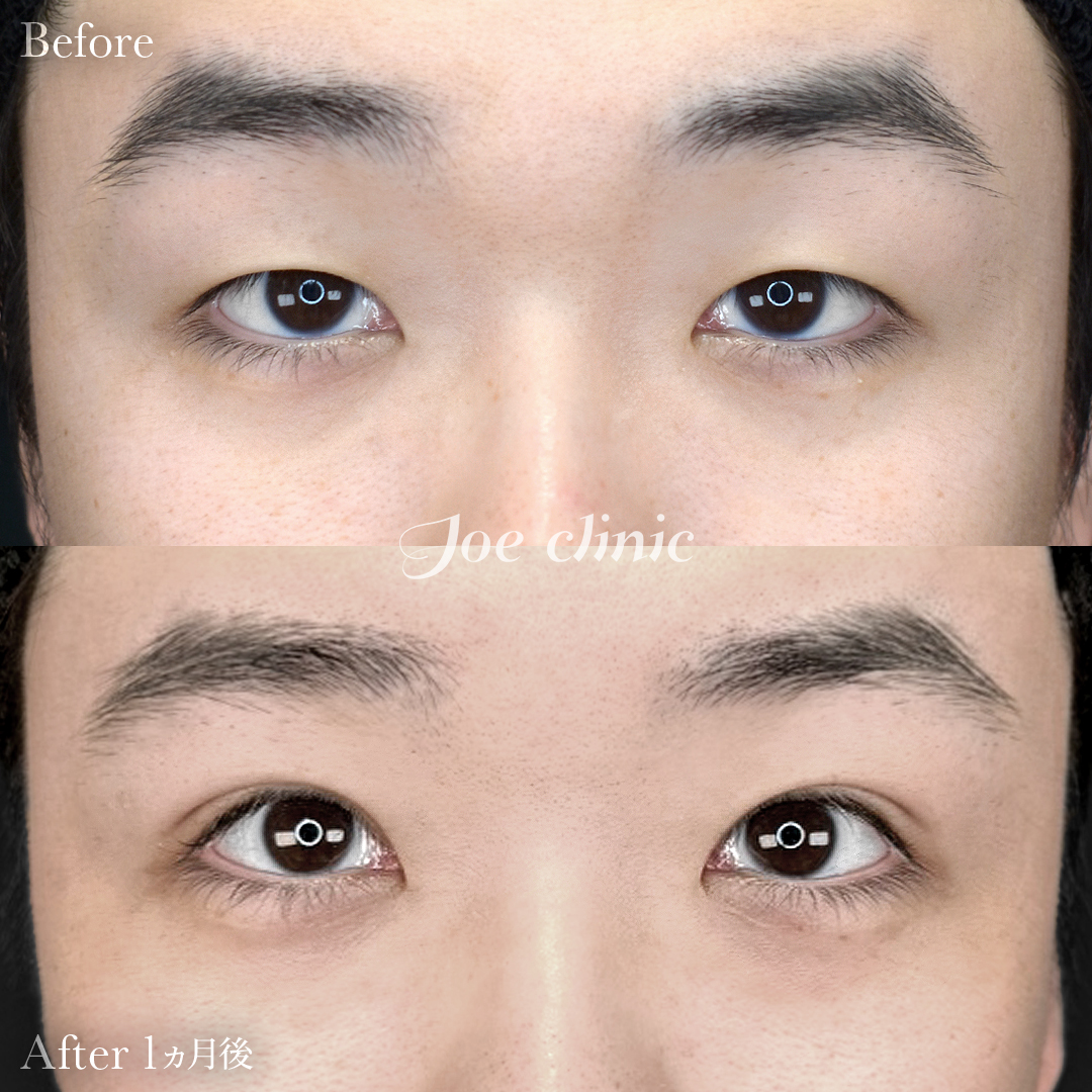 【20代男性】韓国式二重埋没法6点留め｜1ヵ月後