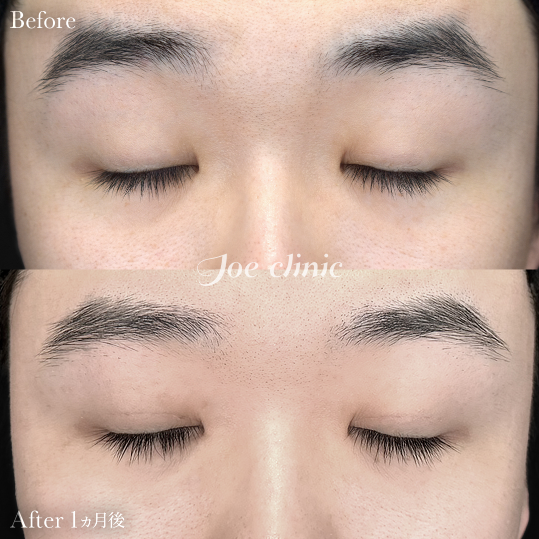 【20代男性】韓国式二重埋没法6点留め｜1ヵ月後