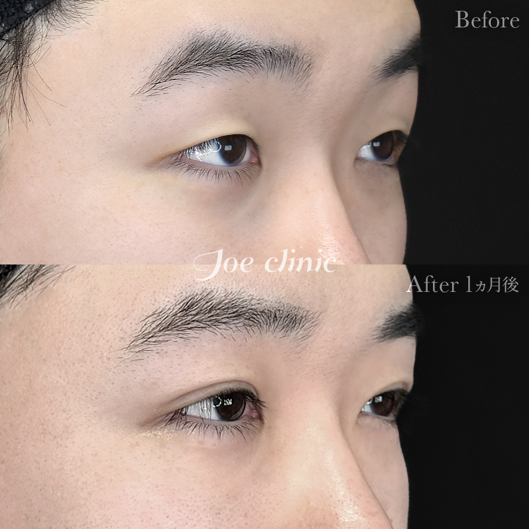 【20代男性】韓国式二重埋没法6点留め｜1ヵ月後