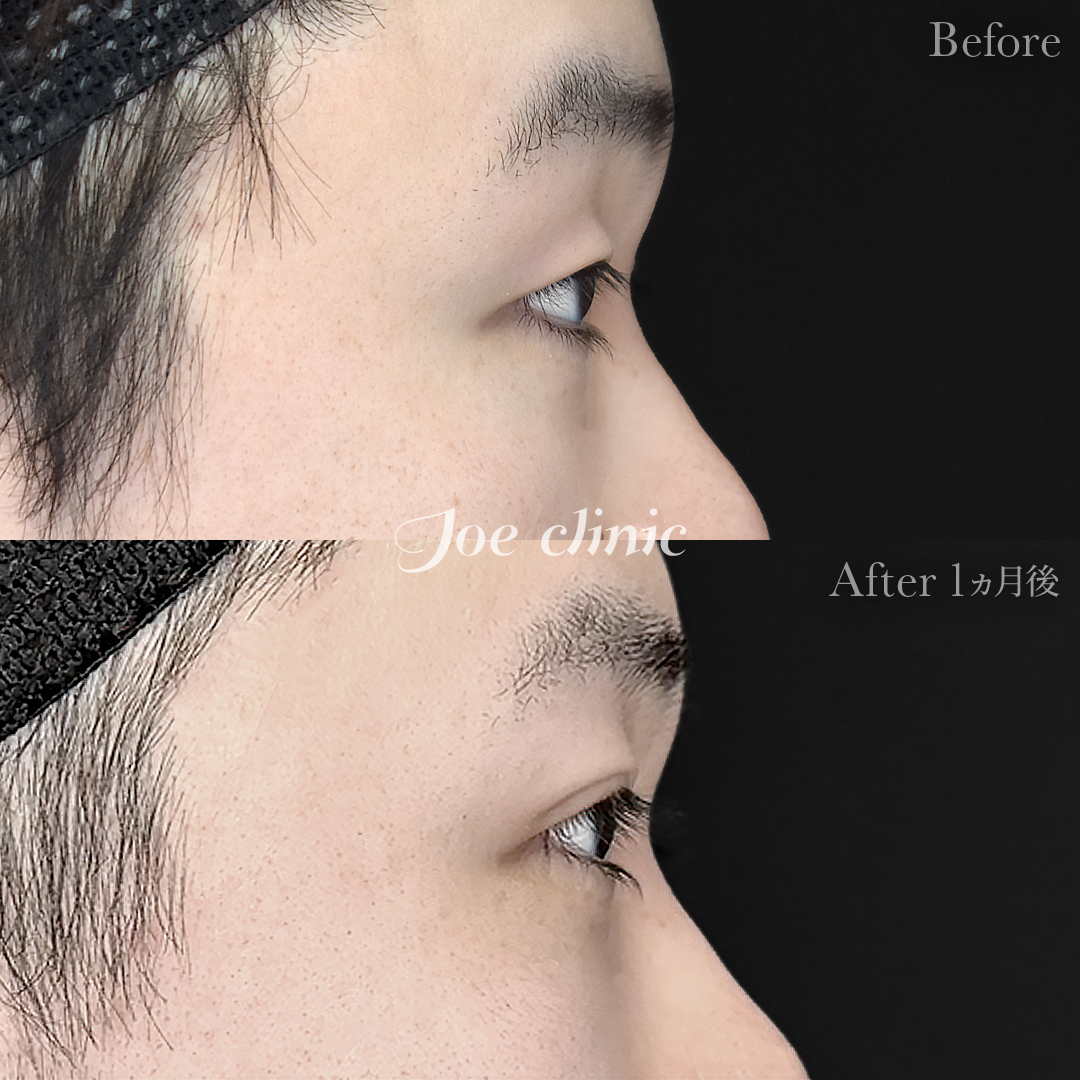 【20代男性】韓国式二重埋没法6点留め｜1ヵ月後