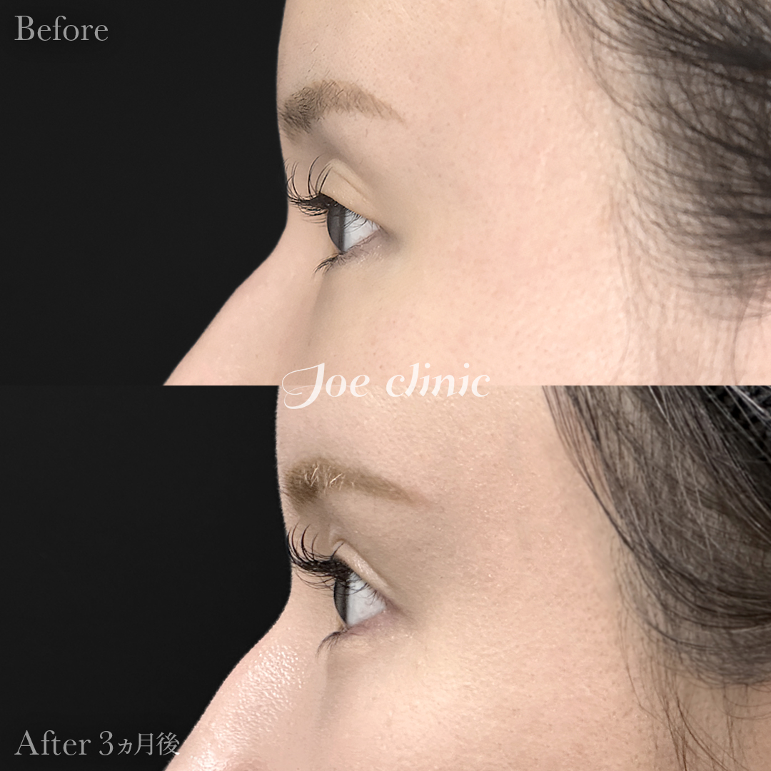 【20代女性】二重埋没 ハイブリッドクロス法｜3ヵ月後