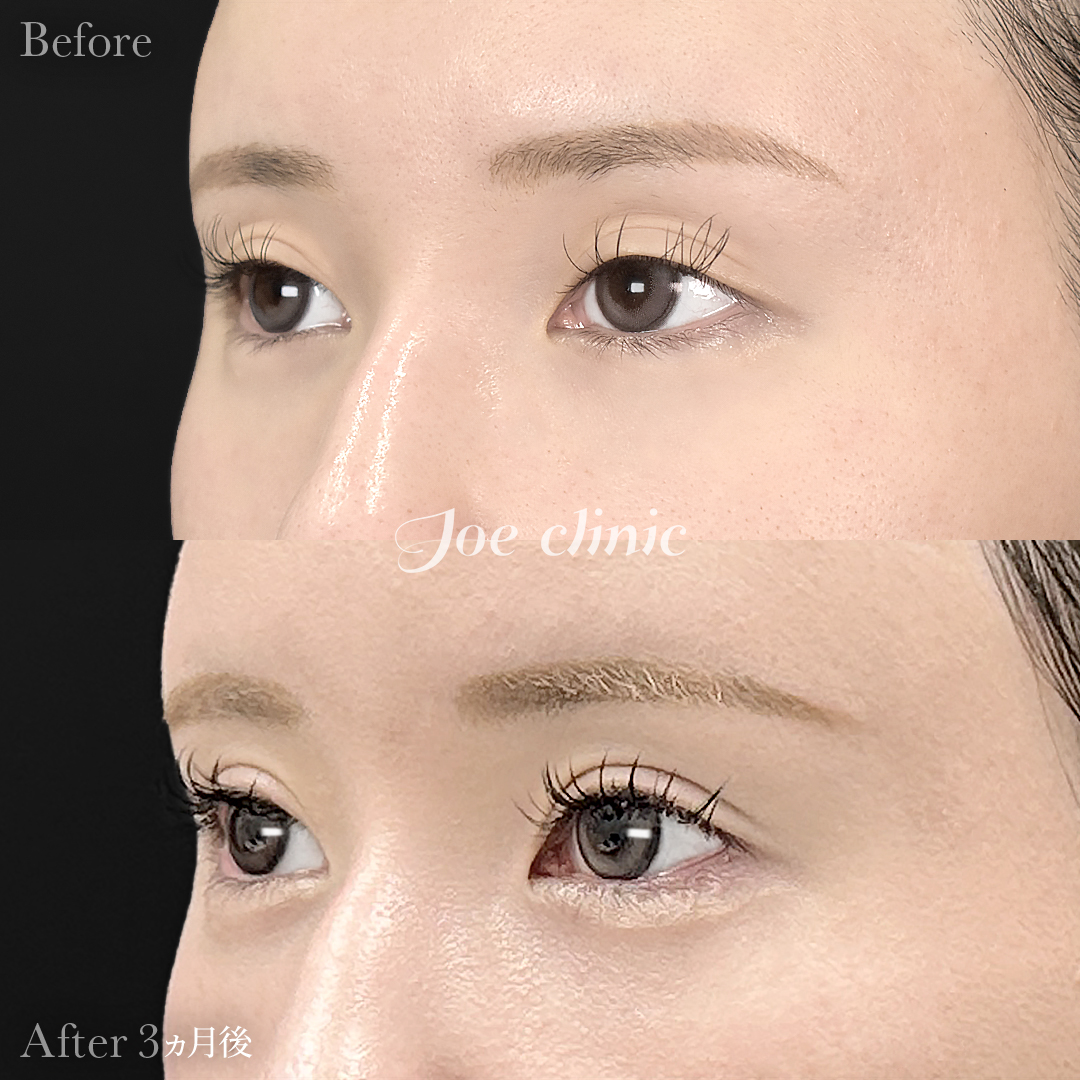 【20代女性】二重埋没 ハイブリッドクロス法｜3ヵ月後