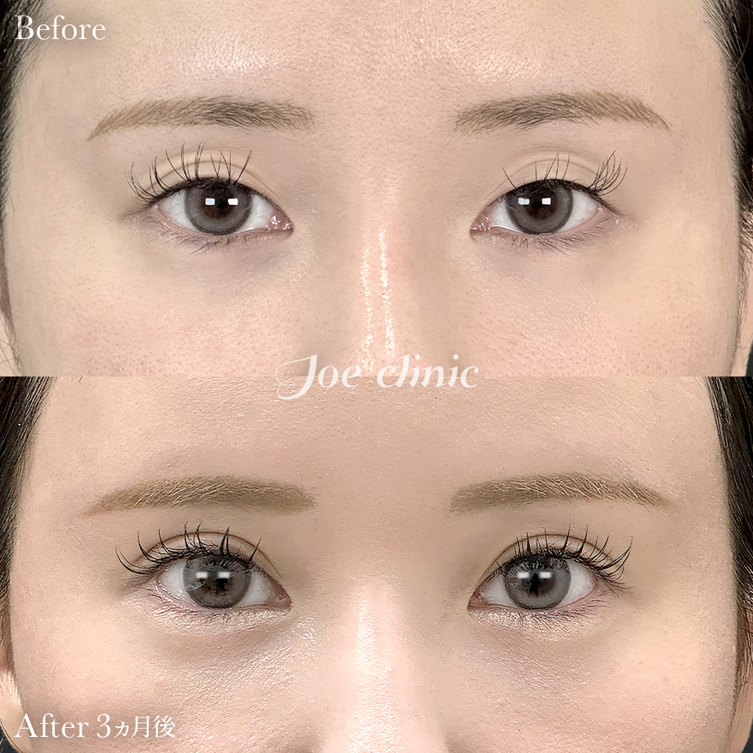 【20代女性】二重埋没 ハイブリッドクロス法｜3ヵ月後