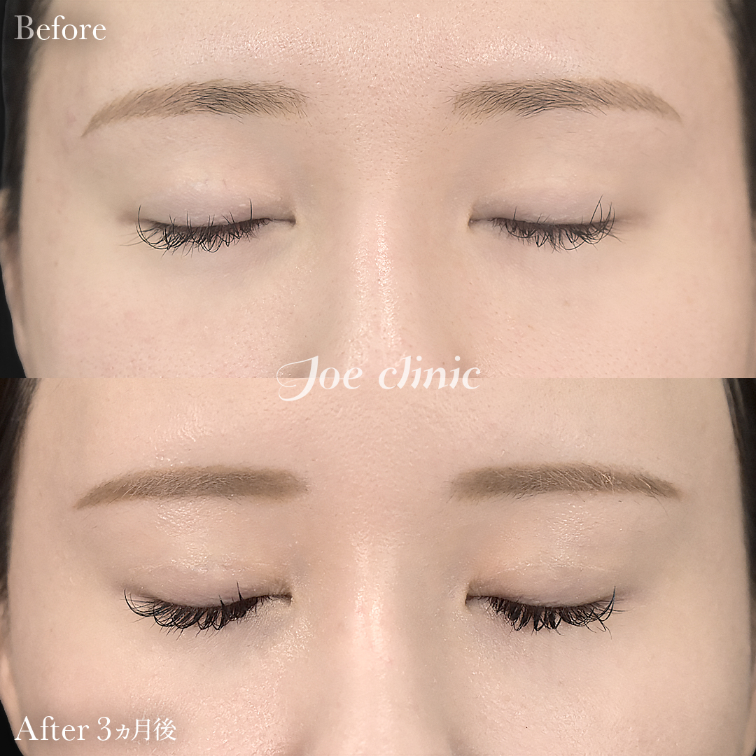 【20代女性】二重埋没 ハイブリッドクロス法｜3ヵ月後