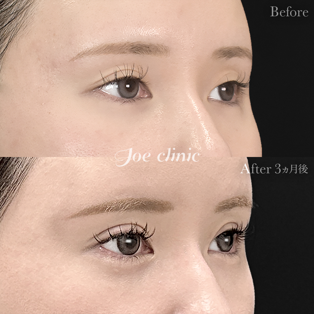 【20代女性】二重埋没 ハイブリッドクロス法｜3ヵ月後