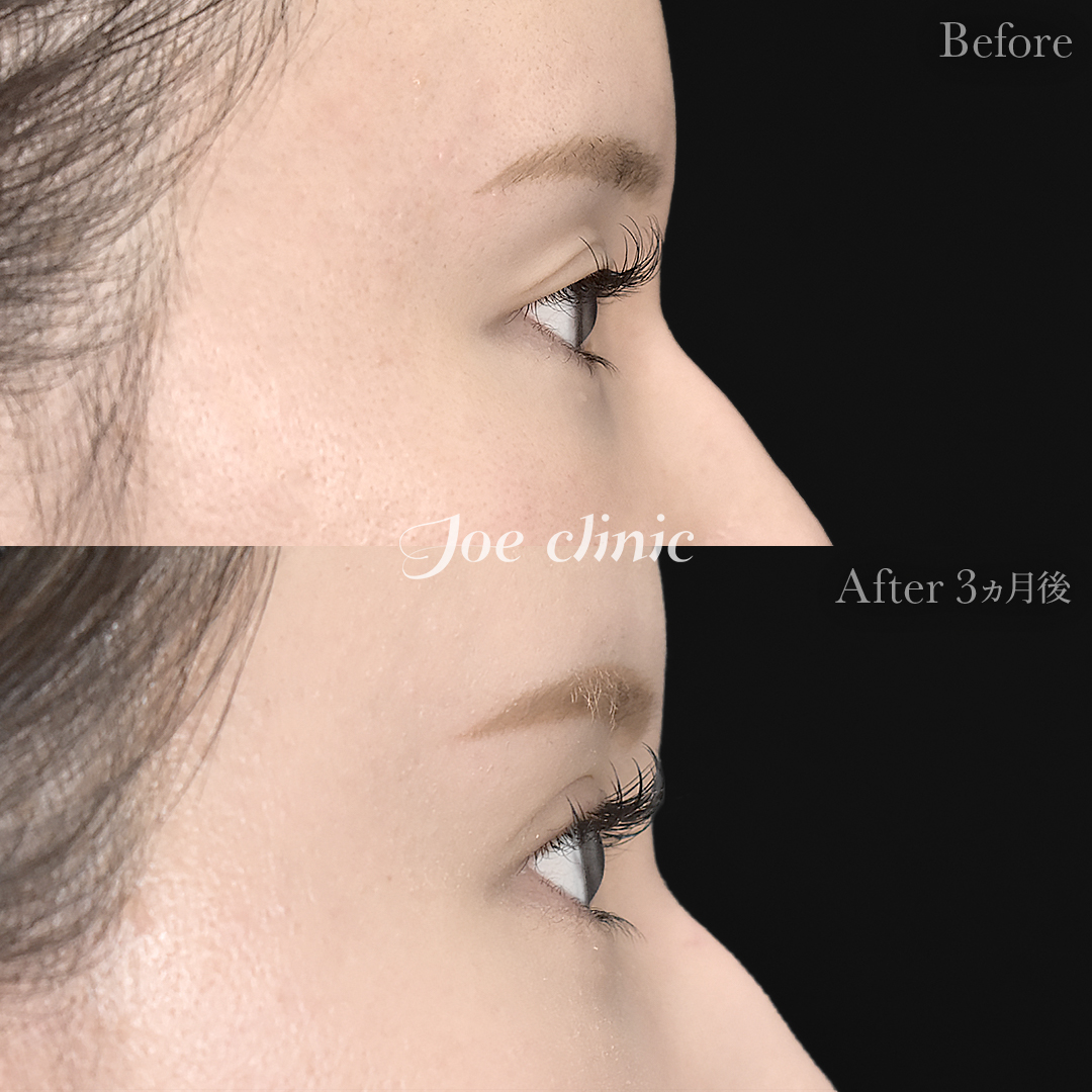 【20代女性】二重埋没 ハイブリッドクロス法｜3ヵ月後