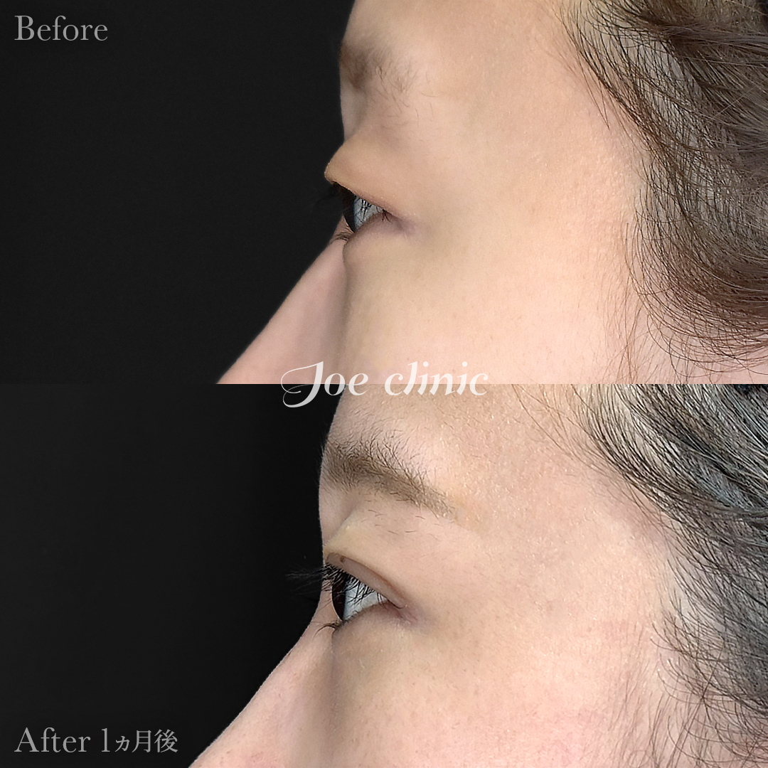 【20代女性】韓国式二重埋没法6点留め｜1ヵ月後