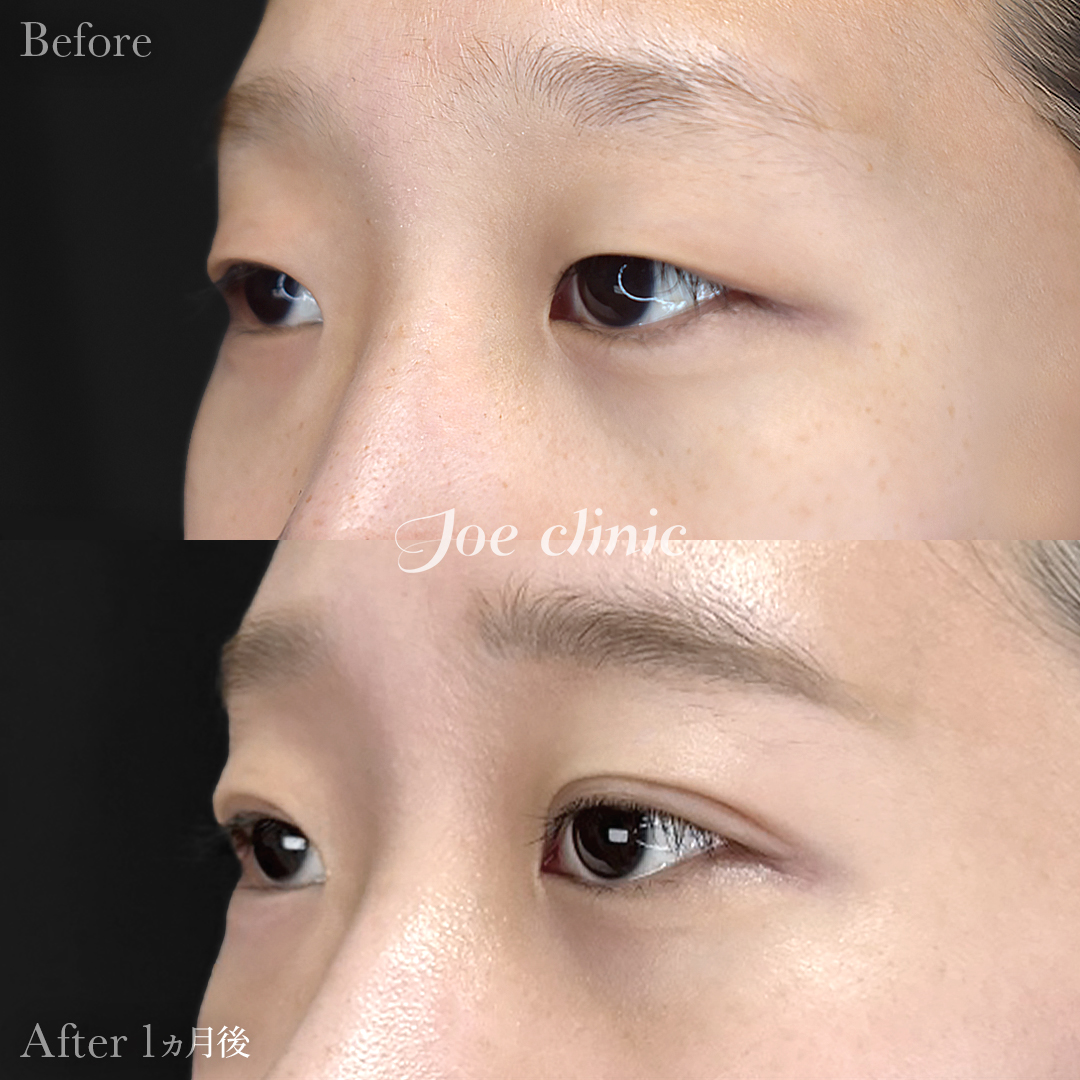 【20代女性】韓国式二重埋没法6点留め｜1ヵ月後