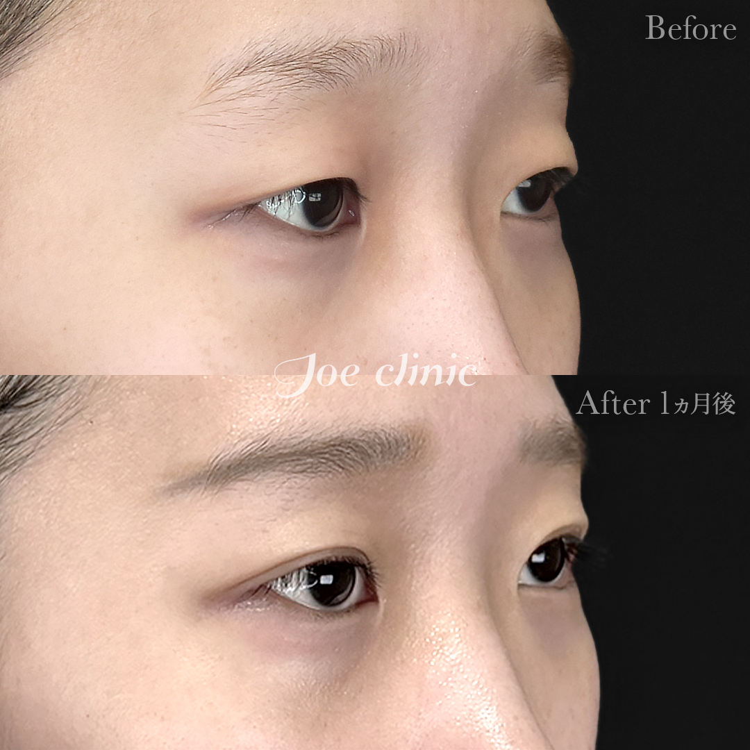 【20代女性】韓国式二重埋没法6点留め｜1ヵ月後