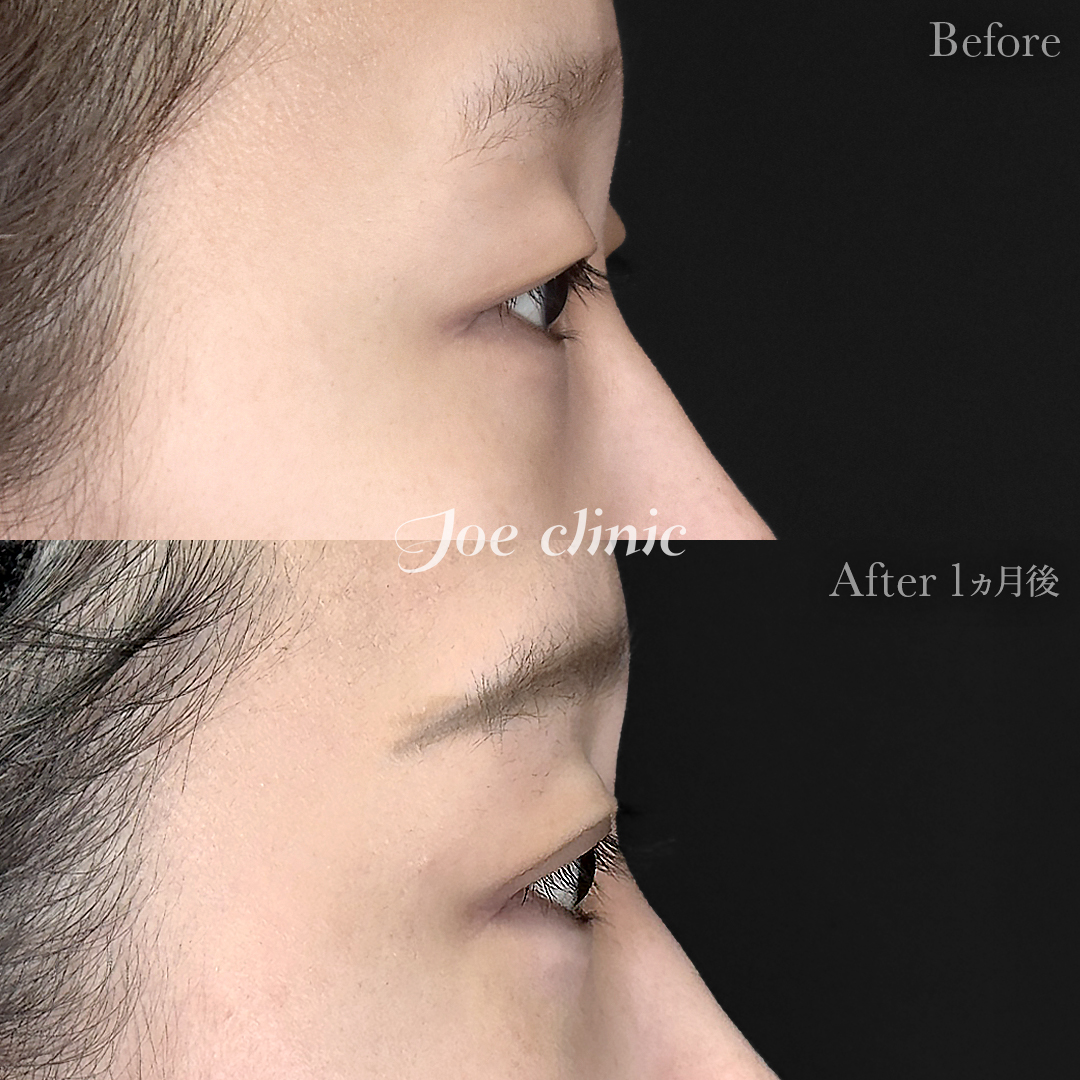 【20代女性】韓国式二重埋没法6点留め｜1ヵ月後