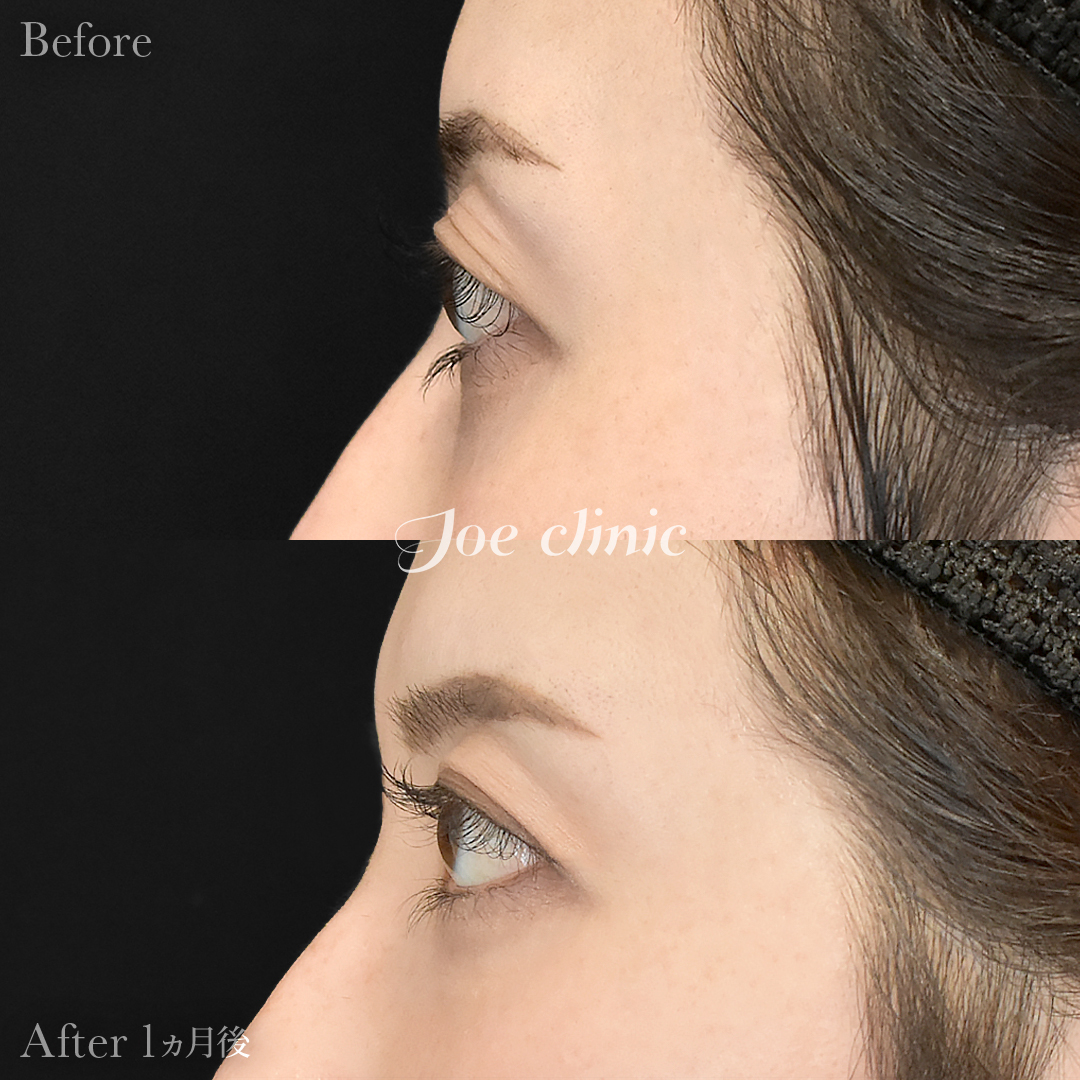 【30代女性】韓国式二重埋没法6点留め｜1ヵ月後