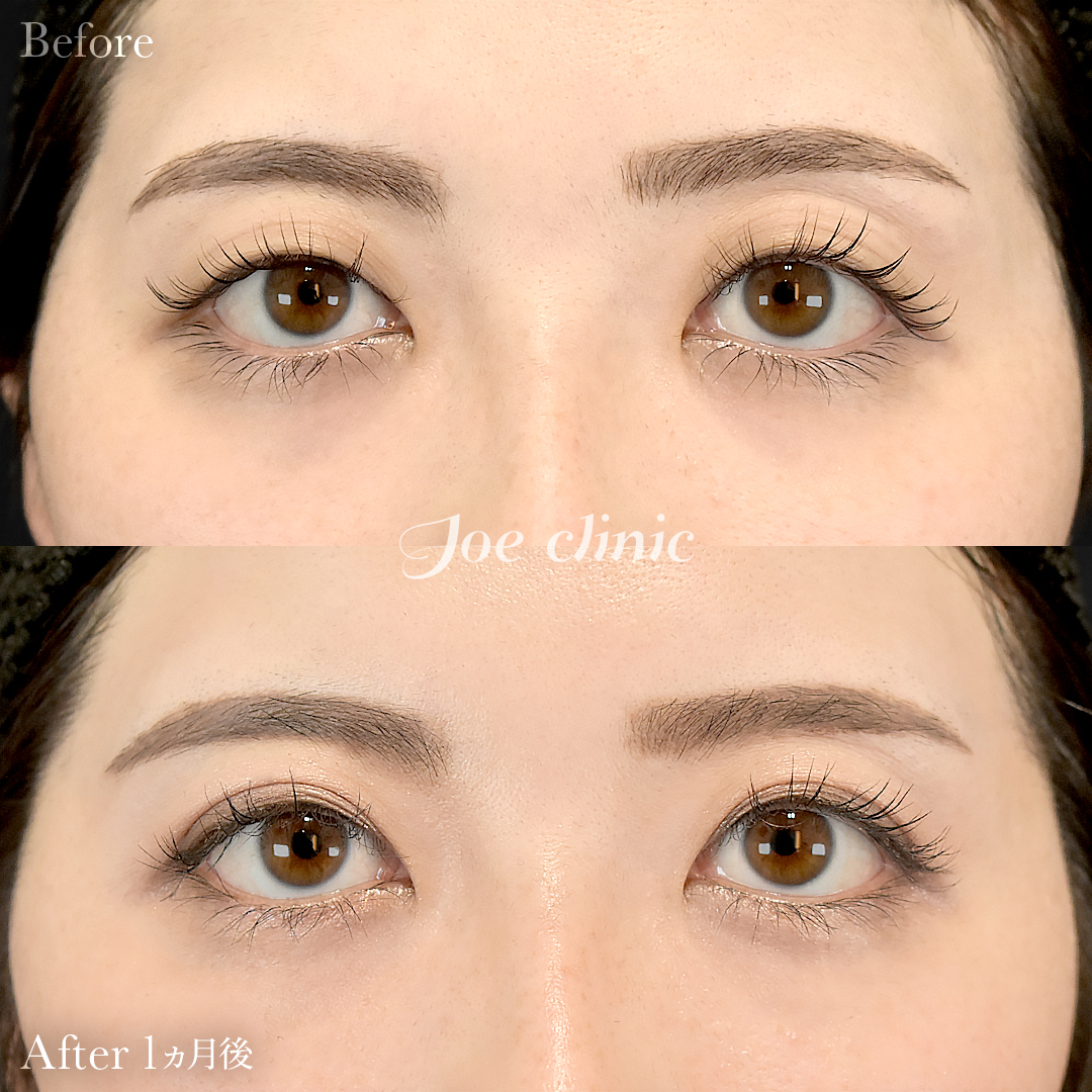 【30代女性】韓国式二重埋没法6点留め|1ヵ月後