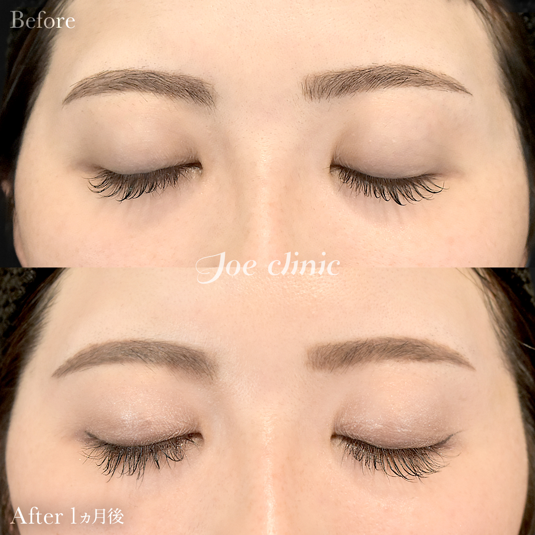 【30代女性】韓国式二重埋没法6点留め｜1ヵ月後