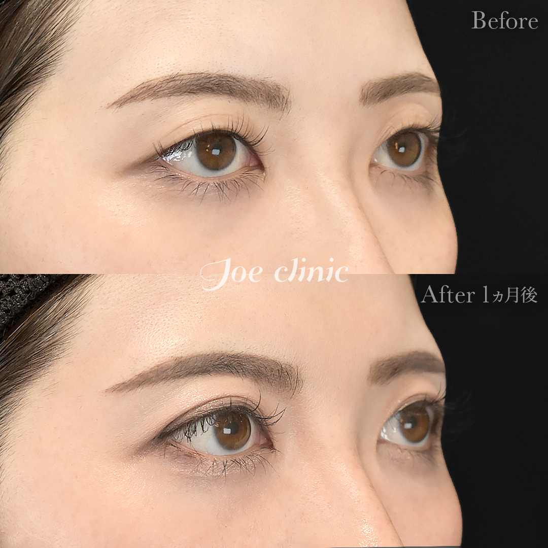 【30代女性】韓国式二重埋没法6点留め｜1ヵ月後