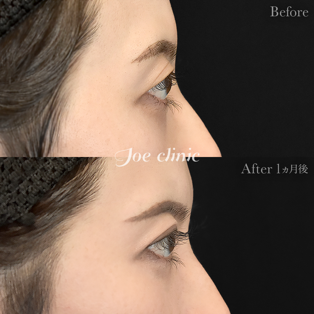 【30代女性】韓国式二重埋没法6点留め｜1ヵ月後