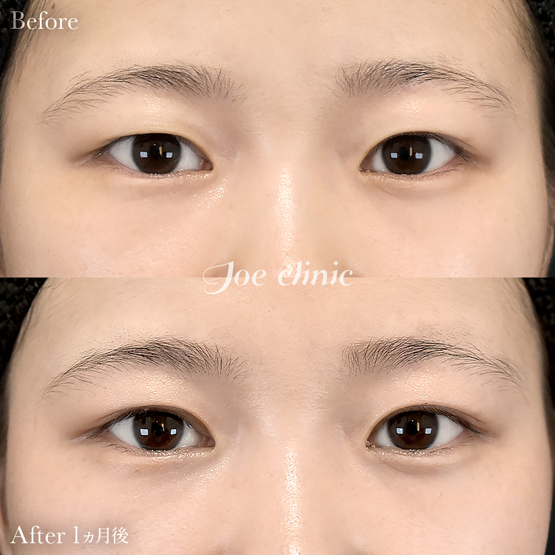 【30代女性】二重全切開法|1ヵ月後