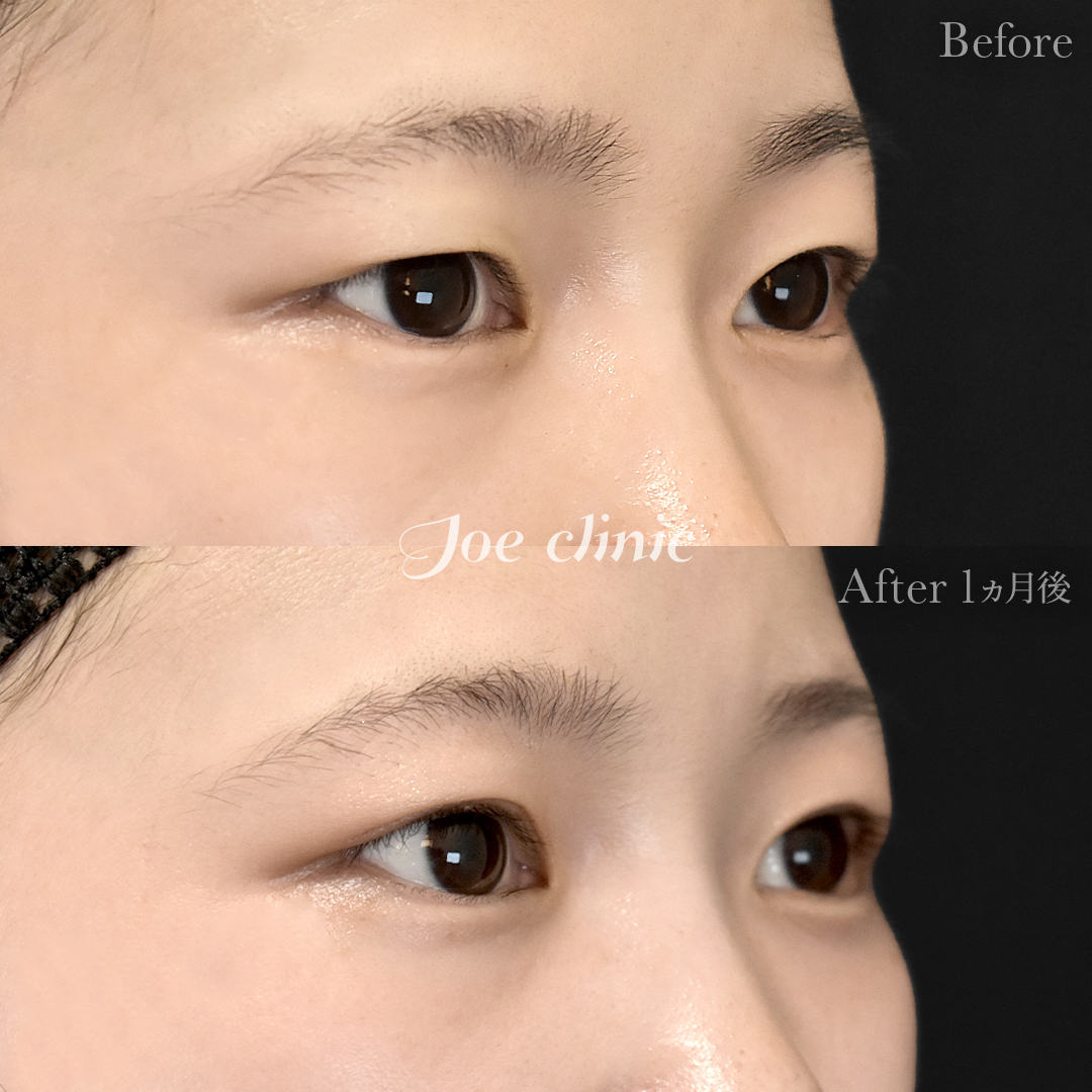 【30代女性】二重全切開法|1ヵ月後