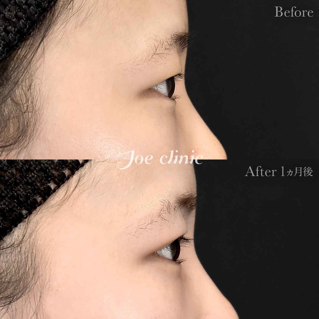 【30代女性】二重全切開法|1ヵ月後