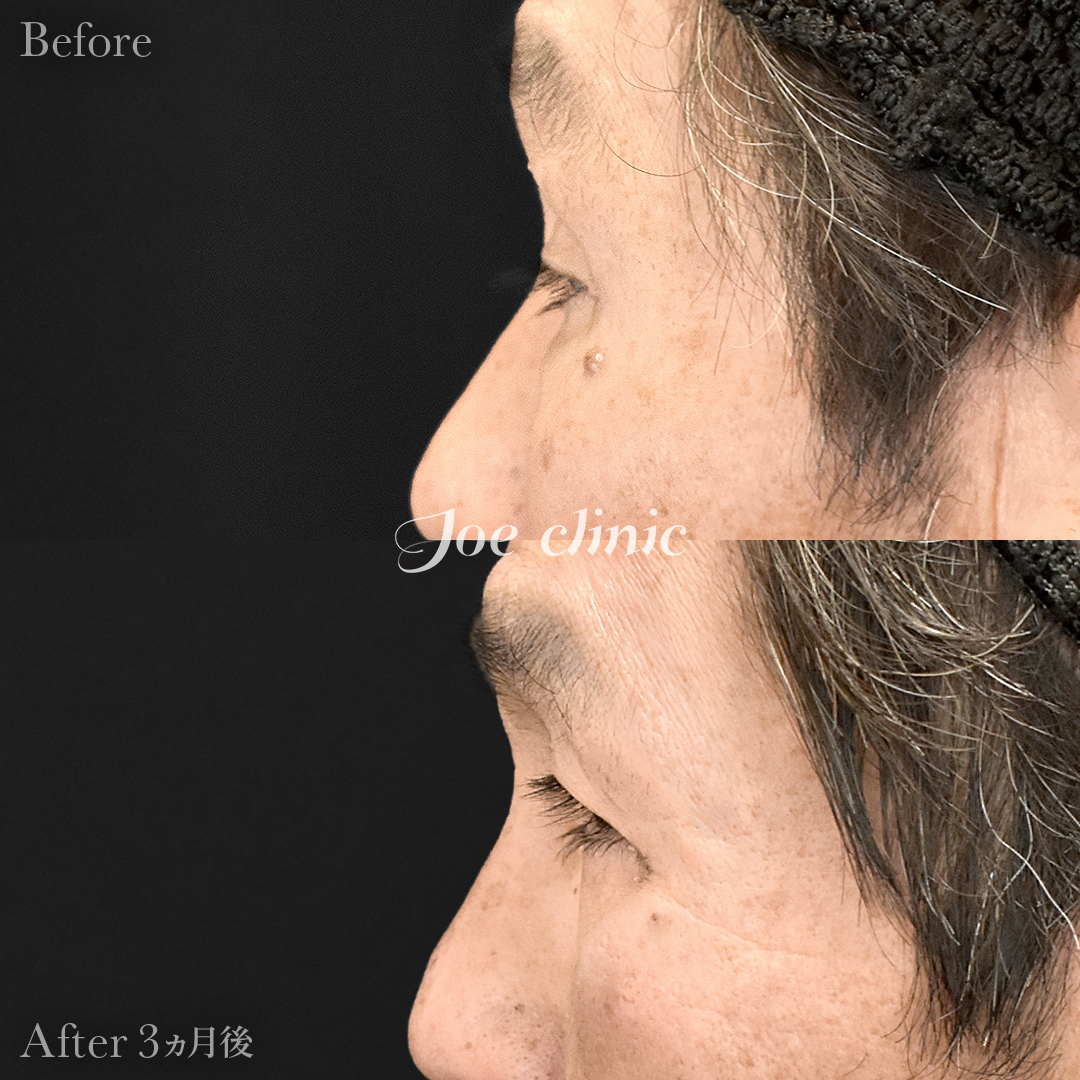 【60代男性】眼瞼下垂(挙筋短縮全切開法)+目の上たるみ取り+目の下のクマ取り(たるみ取り術・ハムラ法)|3ヵ月後