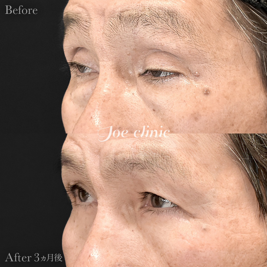 【60代男性】眼瞼下垂(挙筋短縮全切開法)+目の上たるみ取り+目の下のクマ取り(たるみ取り術・ハムラ法)|3ヵ月後