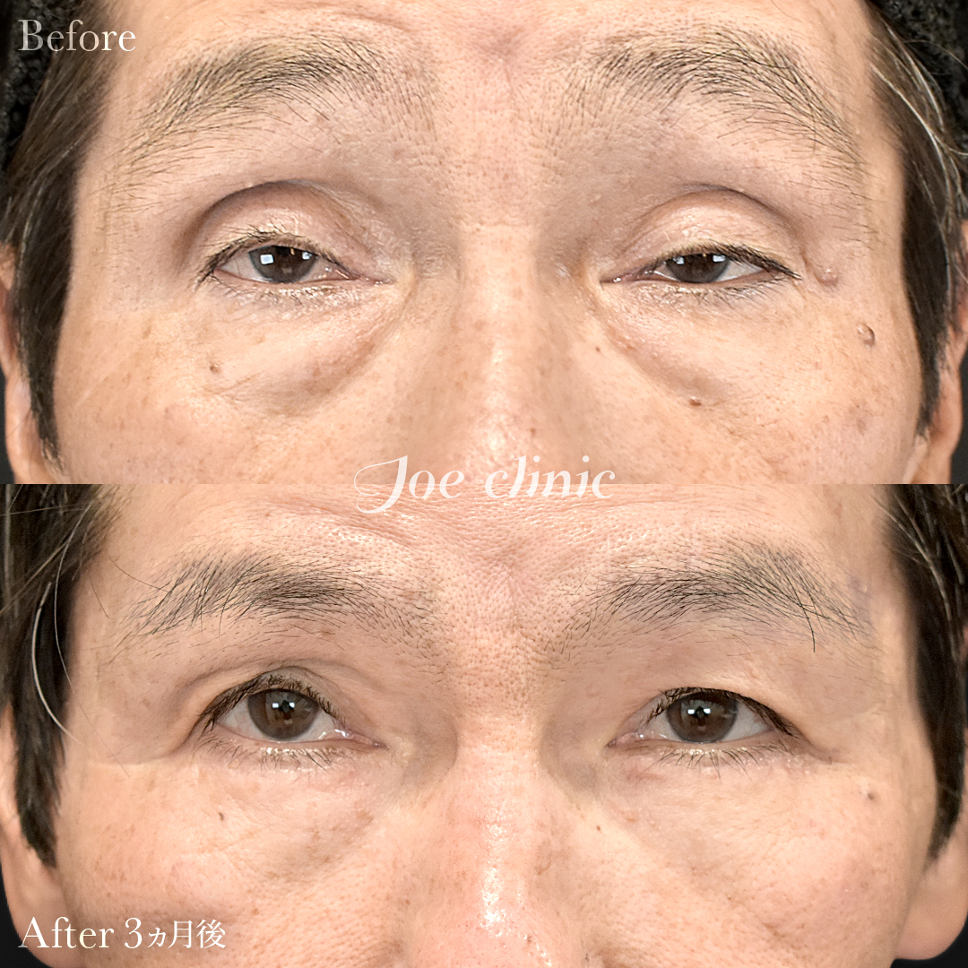 【60代男性】眼瞼下垂(挙筋短縮全切開法)+目の上たるみ取り+目の下のクマ取り(たるみ取り術・ハムラ法)|3ヵ月後