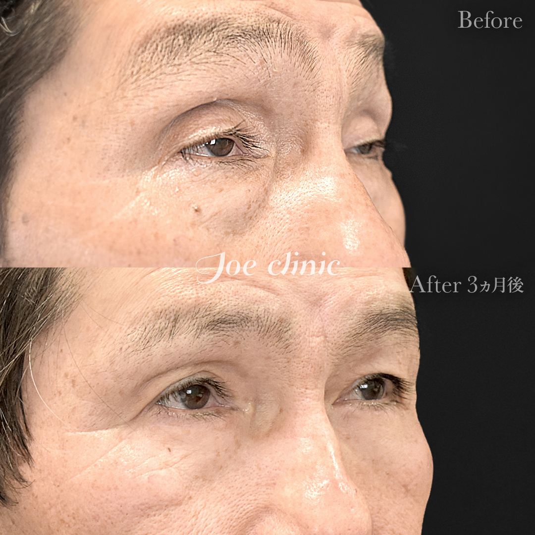 【60代男性】眼瞼下垂(挙筋短縮全切開法)+目の上たるみ取り+目の下のクマ取り(たるみ取り術・ハムラ法)|3ヵ月後