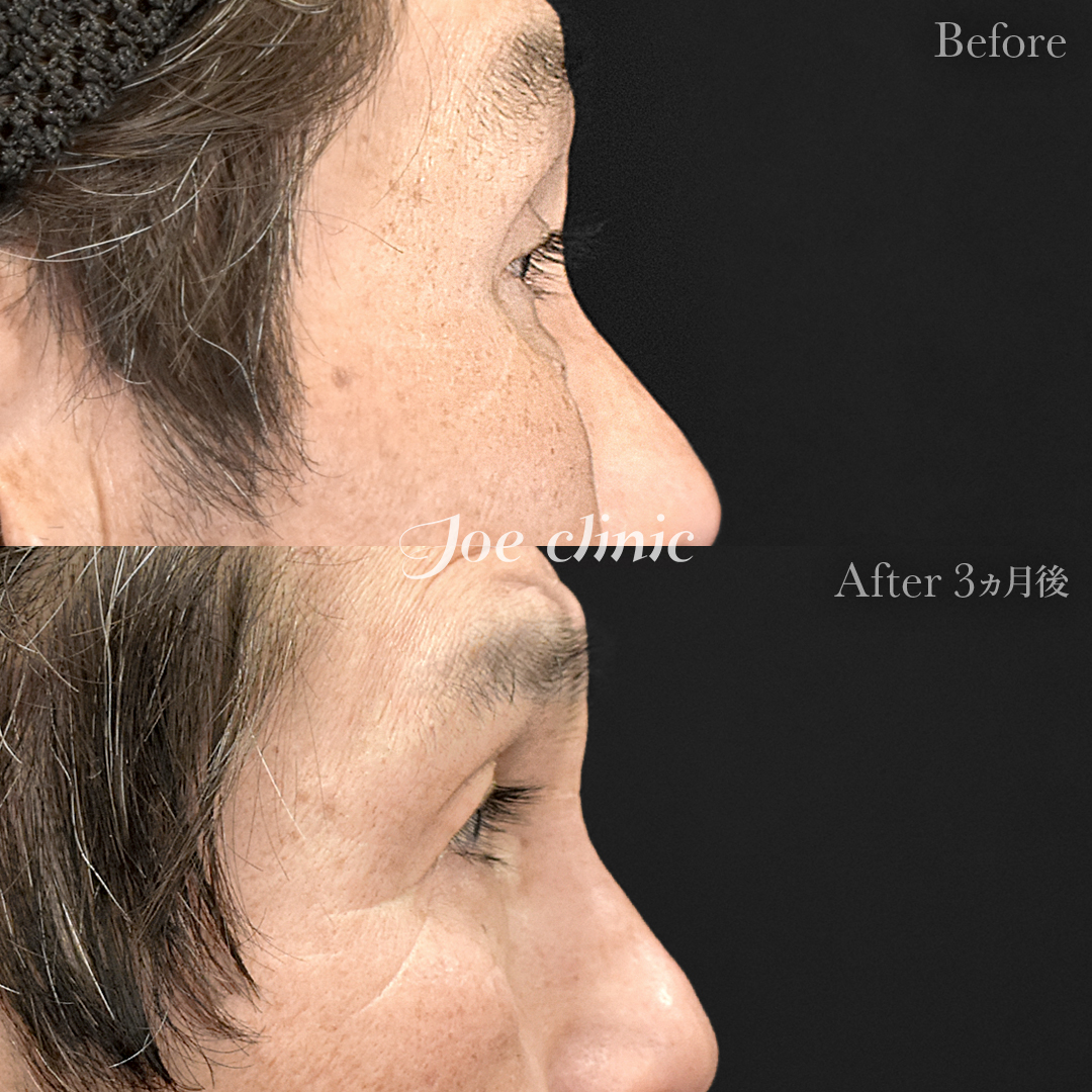 【60代男性】眼瞼下垂(挙筋短縮全切開法)+目の上たるみ取り+目の下のクマ取り(たるみ取り術・ハムラ法)|3ヵ月後