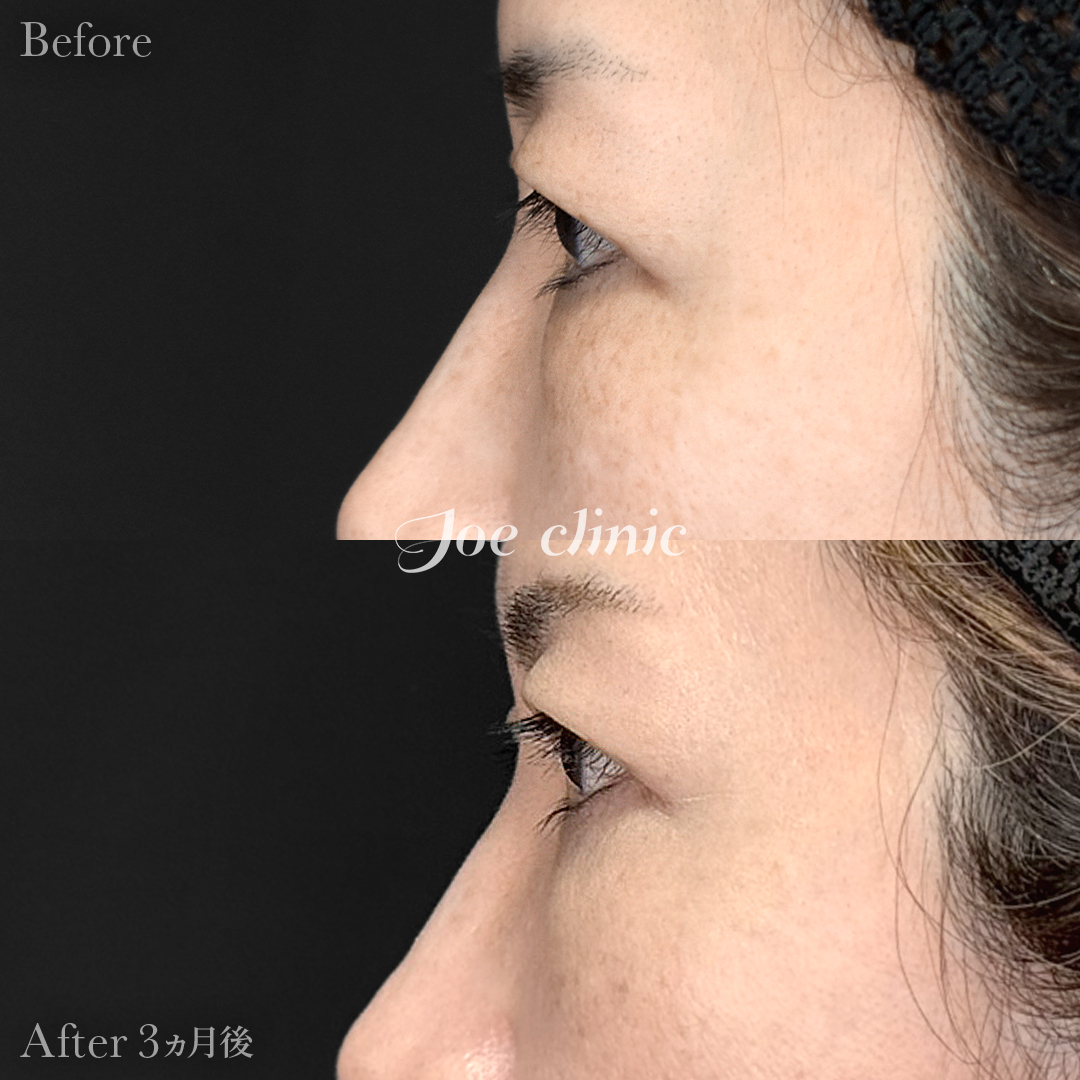 【50代女性】目の下のクマ取り(裏ハムラ法)|3ヵ月後