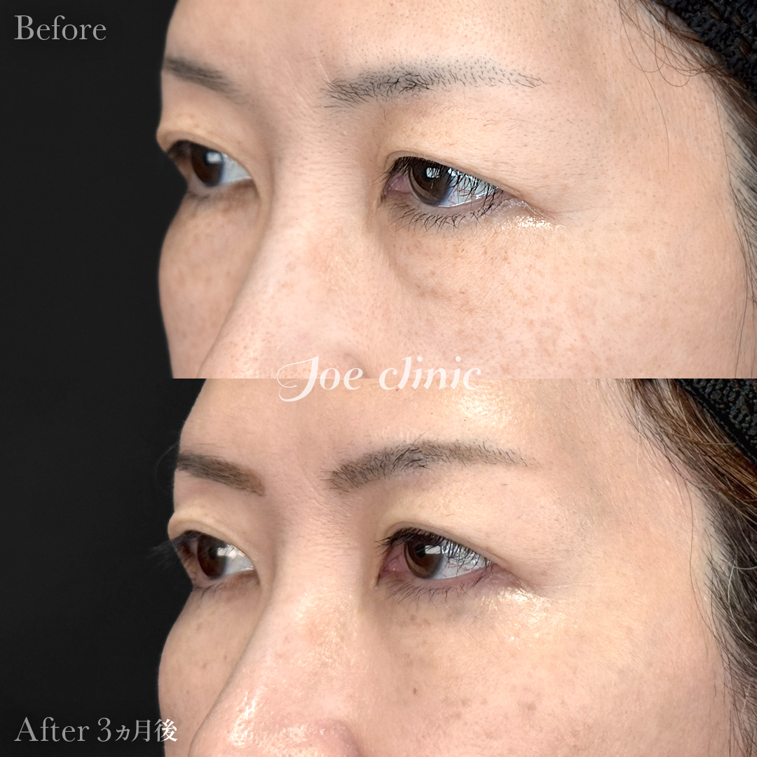 【50代女性】目の下のクマ取り(裏ハムラ法)|3ヵ月後