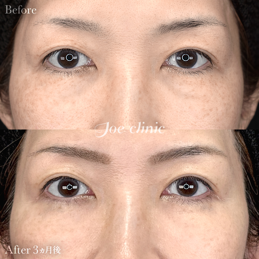 【50代女性】目の下のクマ取り(裏ハムラ法)|3ヵ月後