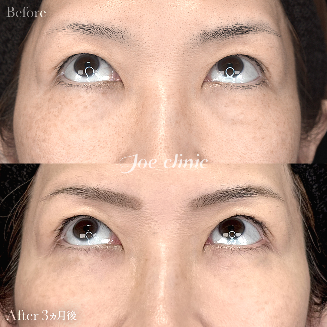 【50代女性】目の下のクマ取り(裏ハムラ法)|3ヵ月後