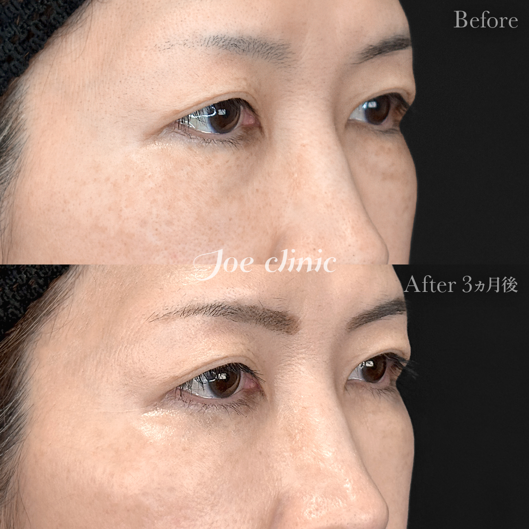 【50代女性】目の下のクマ取り(裏ハムラ法)|3ヵ月後