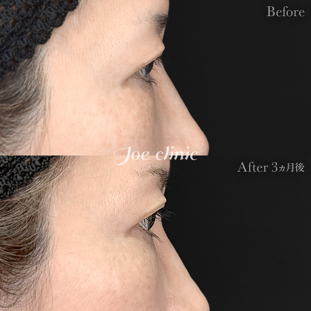 【50代女性】目の下のクマ取り(裏ハムラ法)|3ヵ月後