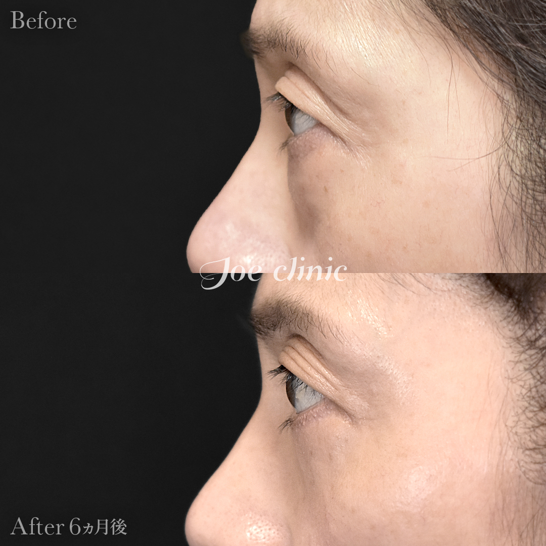 【50代女性】目の下のクマ取り（たるみ取り術・ハムラ法）｜6ヵ月後