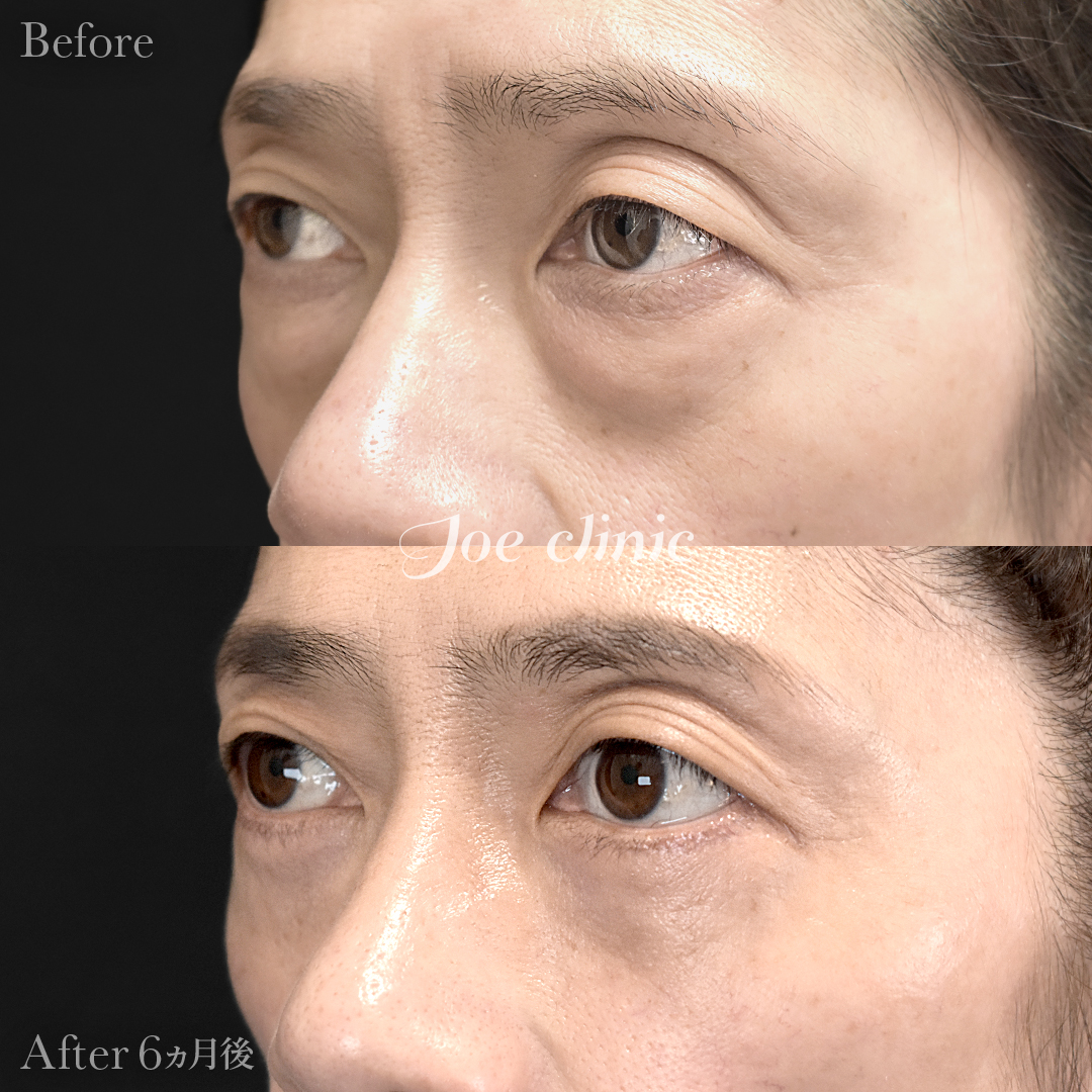 【50代女性】目の下のクマ取り（たるみ取り術・ハムラ法）｜6ヵ月後