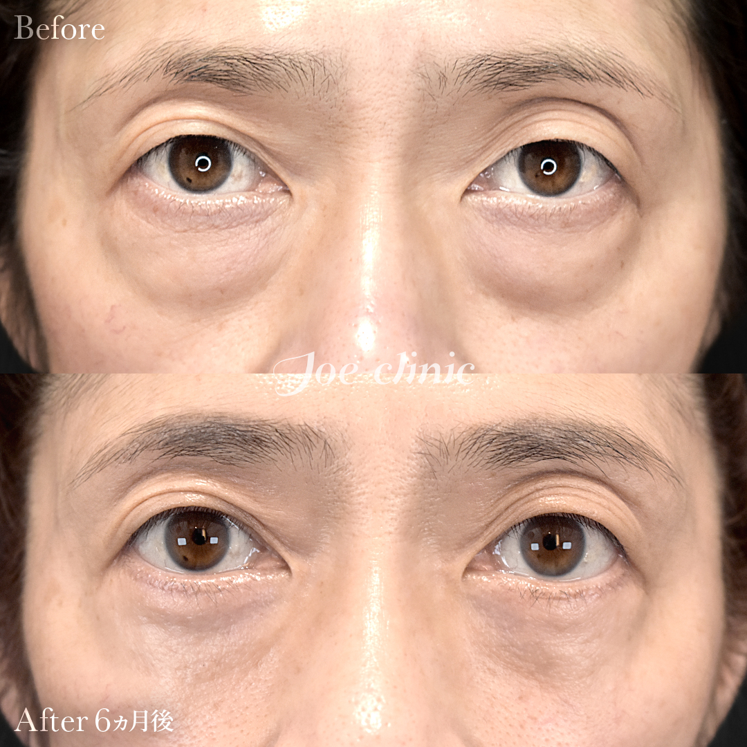 【50代女性】目の下のクマ取り(たるみ取り術・ハムラ法)|6ヵ月後