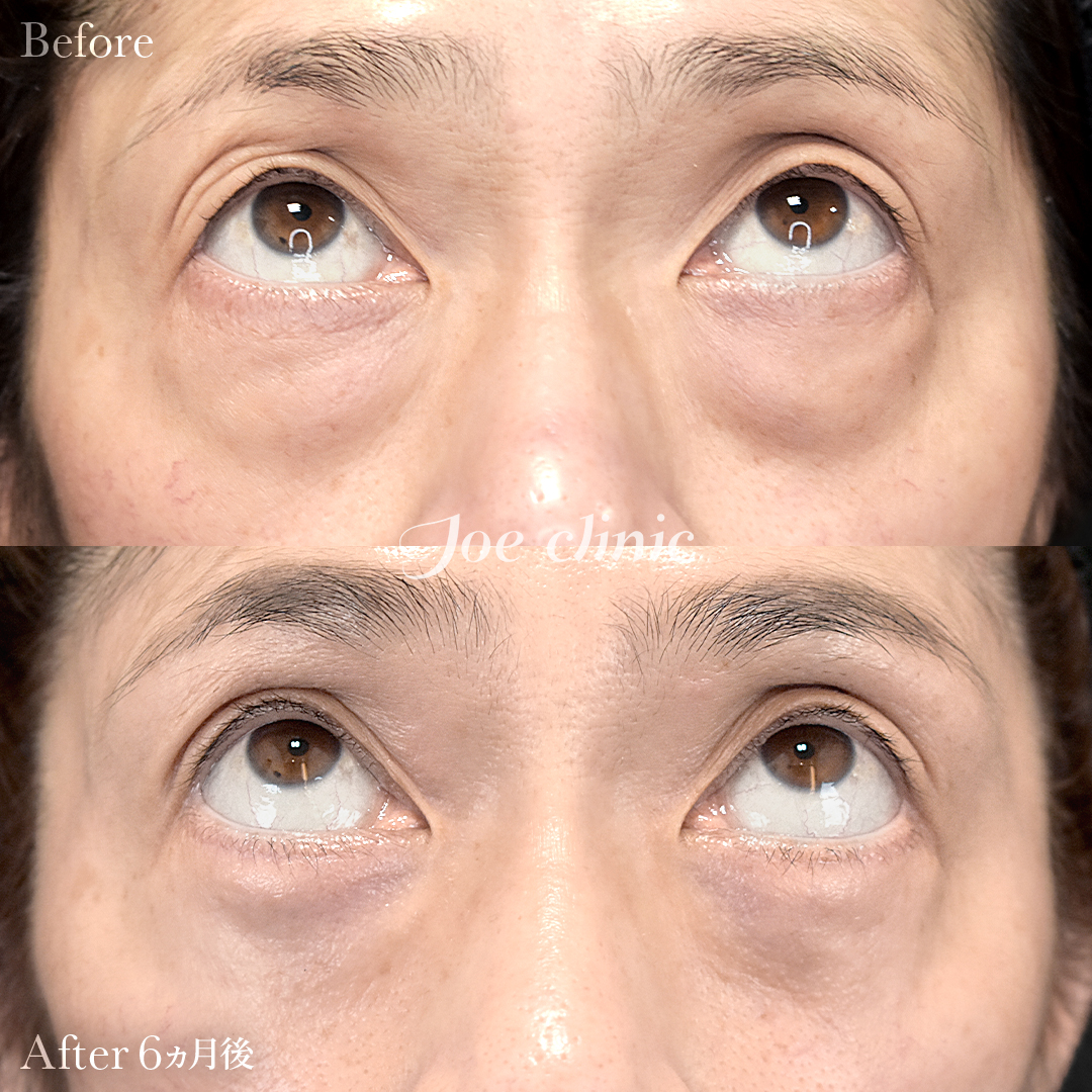 【50代女性】目の下のクマ取り（たるみ取り術・ハムラ法）｜6ヵ月後