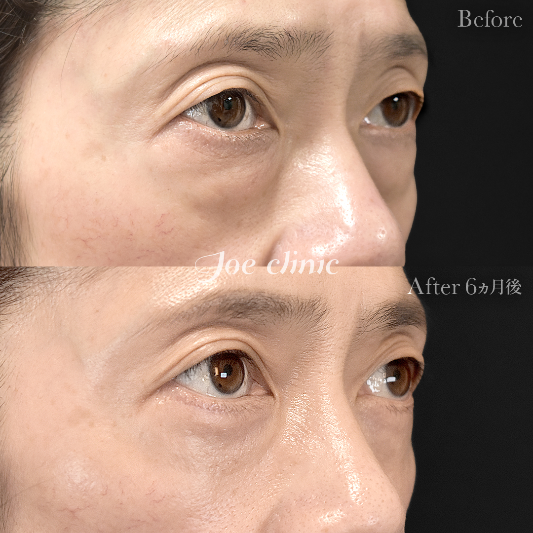 【50代女性】目の下のクマ取り（たるみ取り術・ハムラ法）｜6ヵ月後