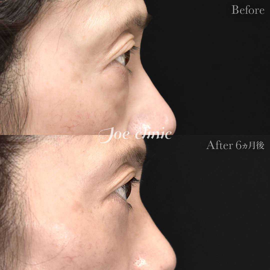 【50代女性】目の下のクマ取り（たるみ取り術・ハムラ法）｜6ヵ月後