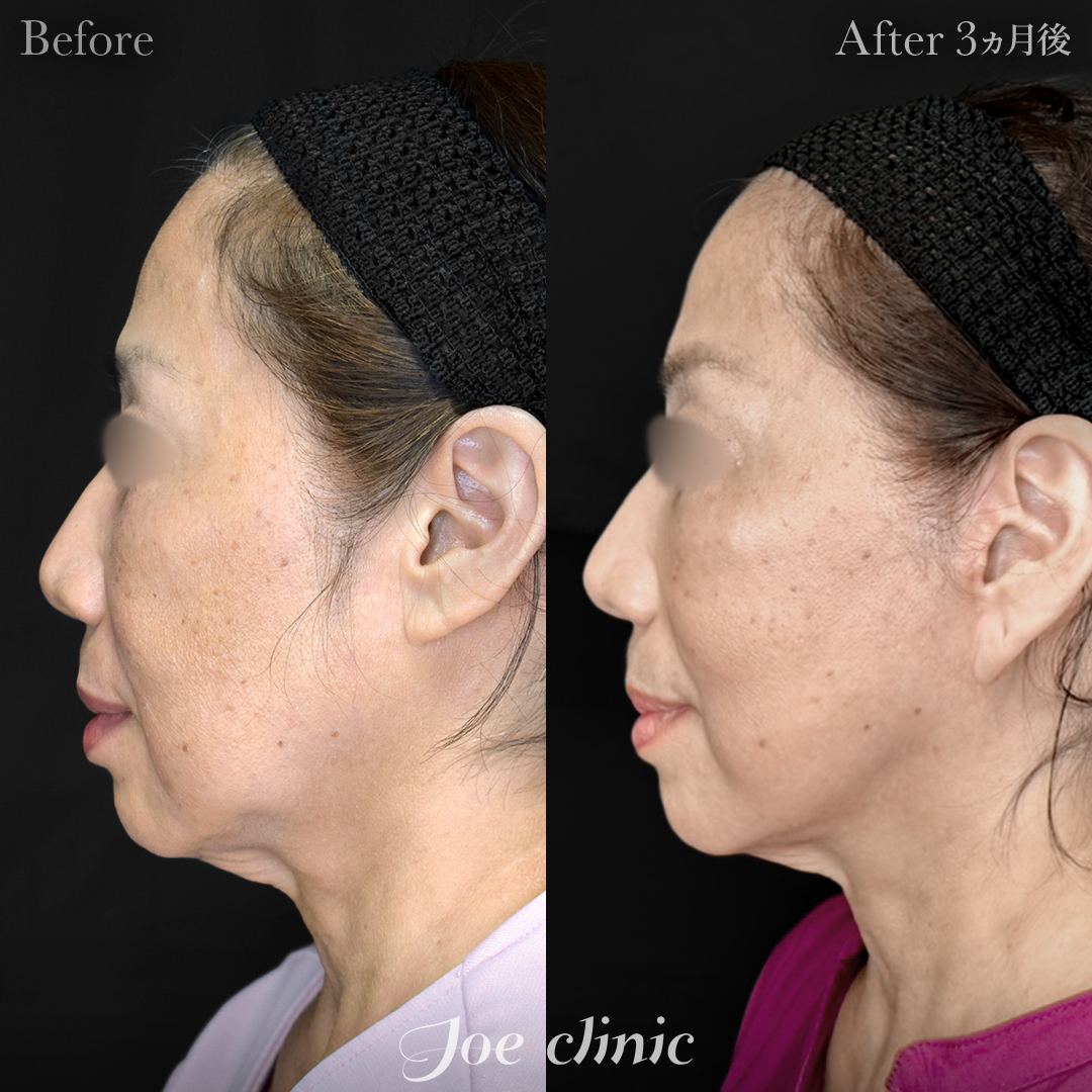 【60代女性】フェイスリフト＋ジョールファット除去｜3ヵ月後