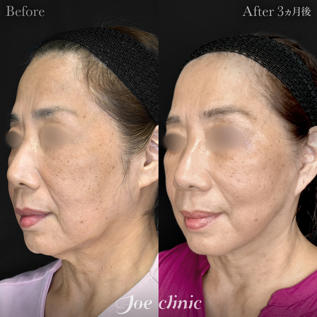 【60代女性】フェイスリフト＋ジョールファット除去｜3ヵ月後