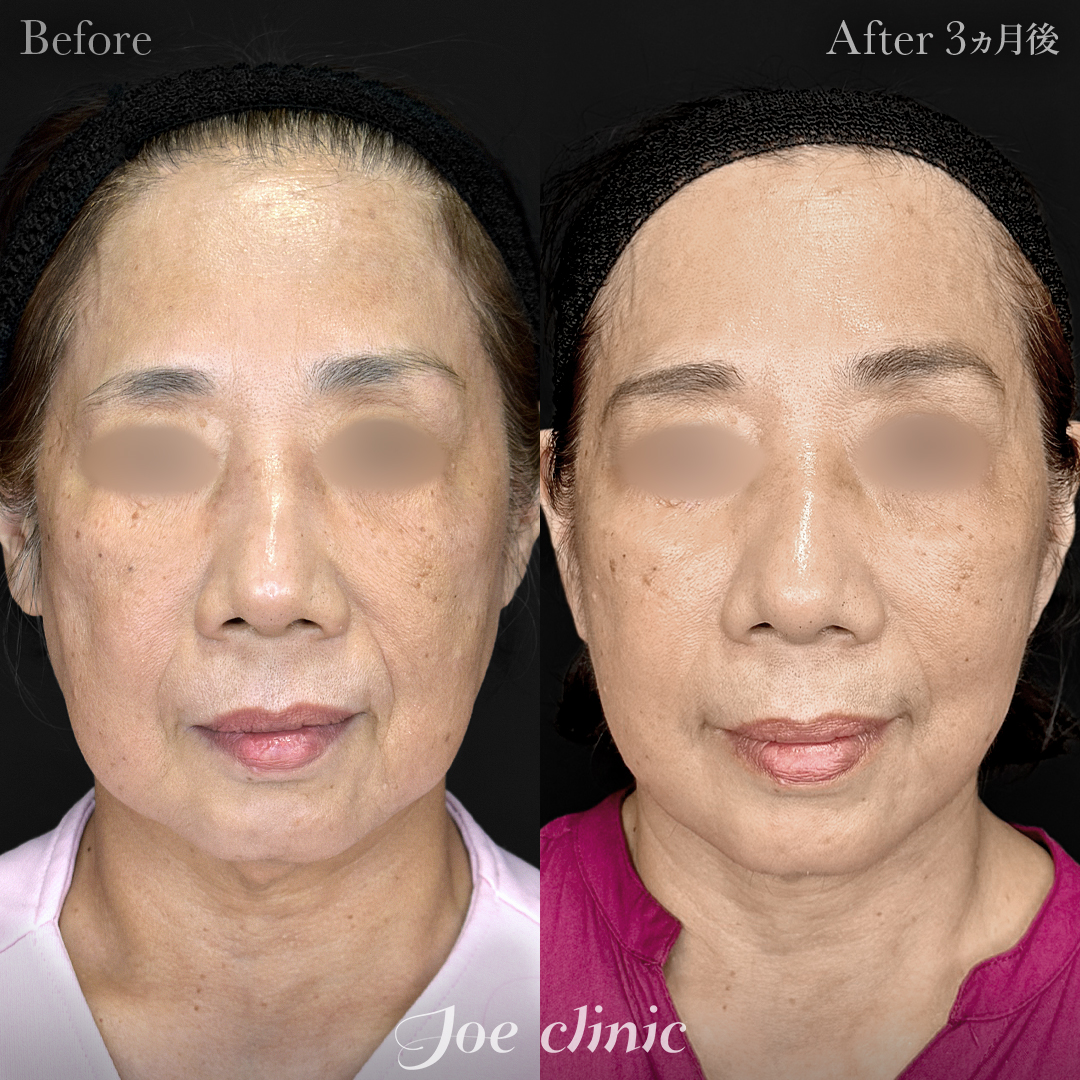 【60代女性】フェイスリフト+ジョールファット除去|3ヵ月後