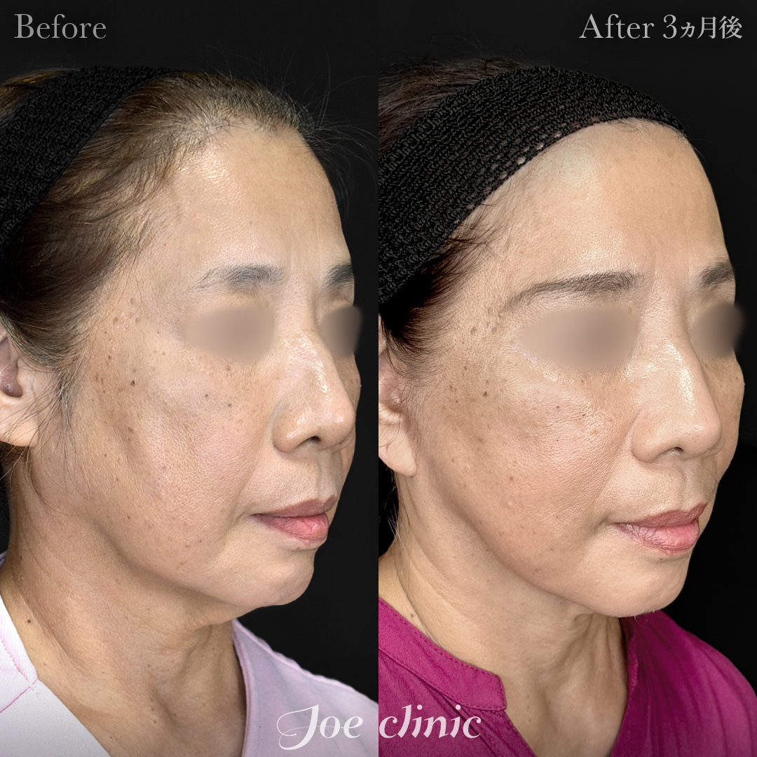【60代女性】フェイスリフト＋ジョールファット除去｜3ヵ月後