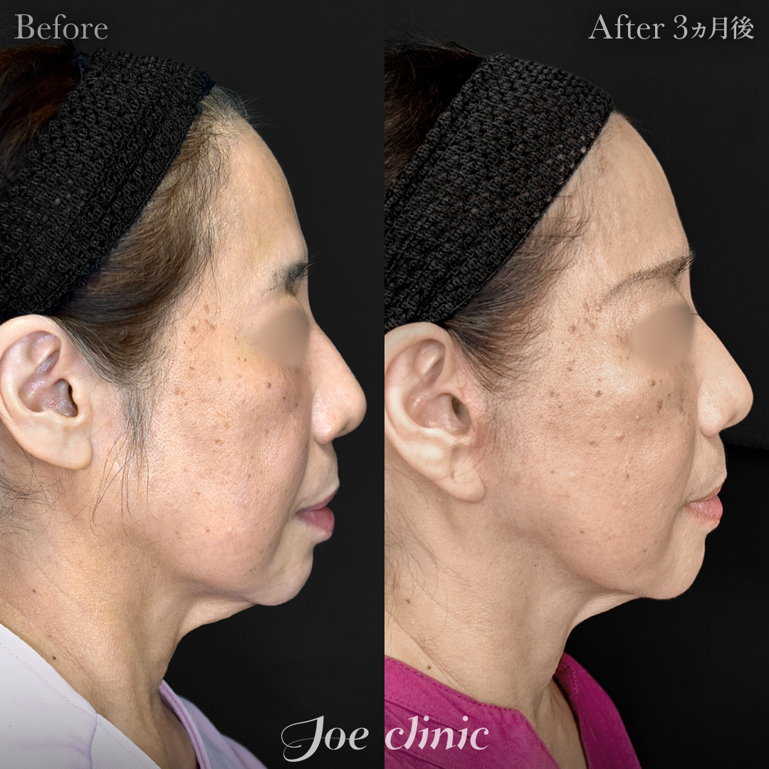 【60代女性】フェイスリフト＋ジョールファット除去｜3ヵ月後