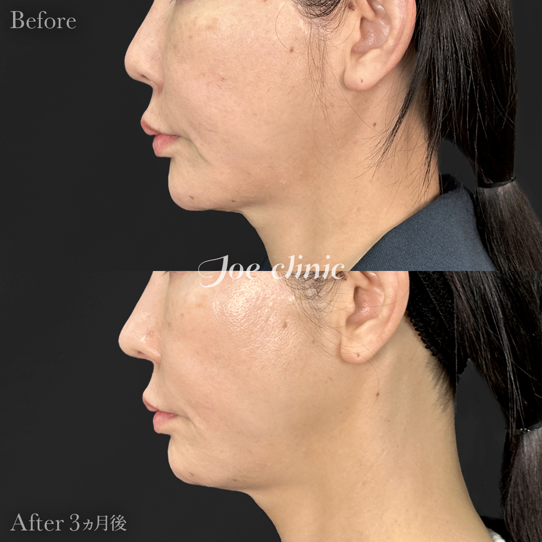 【40代女性】ウルセラリフト(顔全体+顎下)+肌育注射(プルリアル)|3ヵ月後