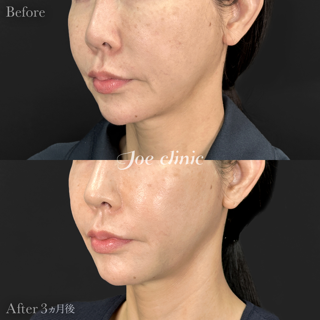 【40代女性】ウルセラリフト(顔全体+顎下)+肌育注射(プルリアル)|3ヵ月後