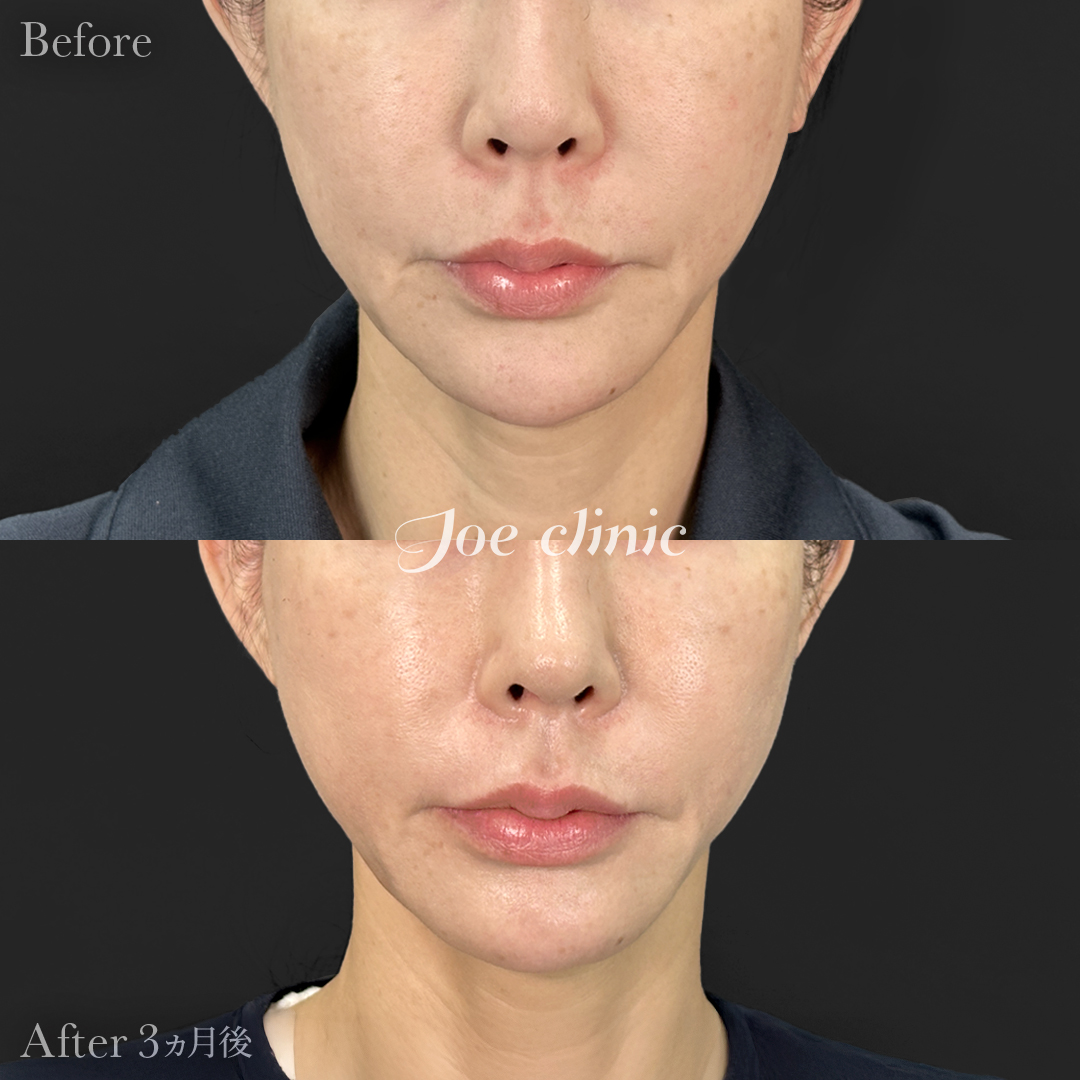 【40代女性】ウルセラリフト(顔全体+顎下)+肌育注射(プルリアル)|3ヵ月後