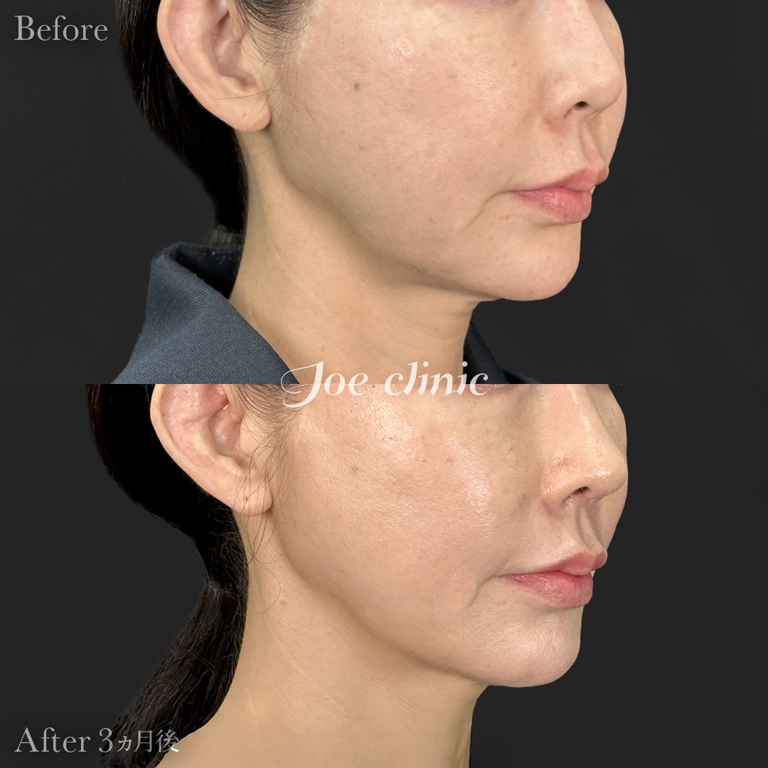 【40代女性】ウルセラリフト(顔全体+顎下)+肌育注射(プルリアル)|3ヵ月後