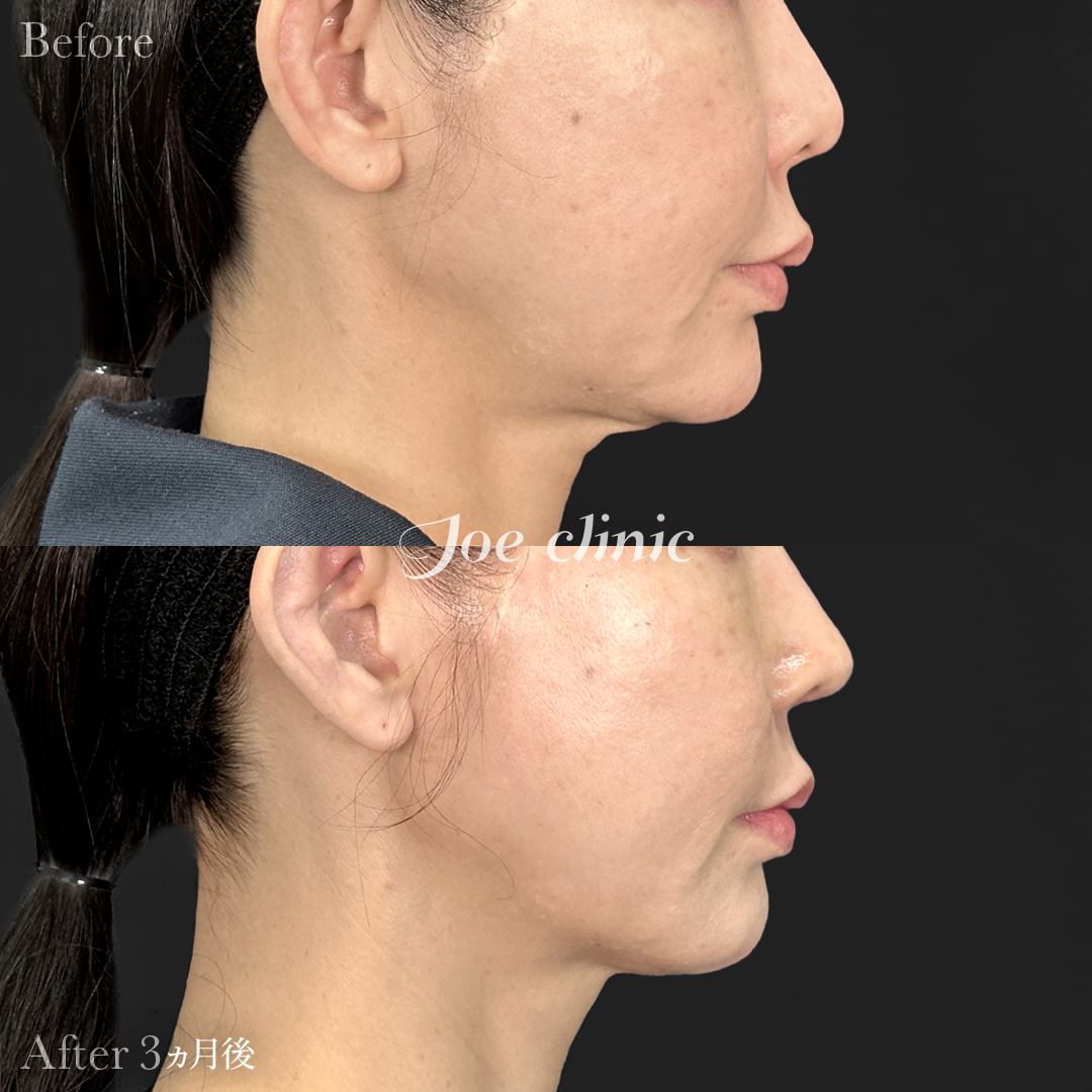 【40代女性】ウルセラリフト(顔全体+顎下)+肌育注射(プルリアル)|3ヵ月後